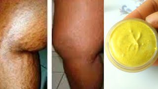 DIY Stretch Mark removal Cream  Remove Stretch marks fast [upl. by Anavoig]