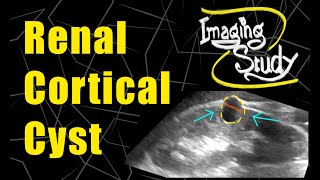 Renal Cortical Cyst  Bosniak GradeII  Ultrasound  Case 89 [upl. by Kary]