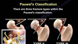 Femoral Neck Fracture Classification  Everything You Need To Know  Dr Nabil Ebraheim [upl. by Nnaihs750]