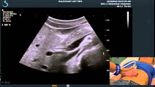 Hot Tips  Locating the Common Bile Duct with Ultrasound [upl. by Anaiad507]