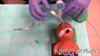 NICU Procedures Surfactant administration in a preterm infant [upl. by Anauqcaj]