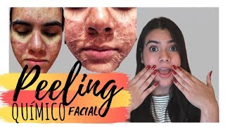 MI EXPERIENCIA PEELING QUÍMICO FACIAL l ACNÉ l PROCESO  ROCIO LUNA [upl. by Hatch]