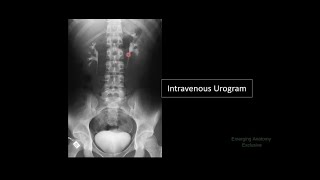 Kidney Ureter Urinary bladder II In the plain Xray KUB and Intravenous urogram [upl. by Ahsitaf]