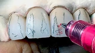 Tooth Morphology Design Techniques for Dental Lab Technicians [upl. by Hairym613]