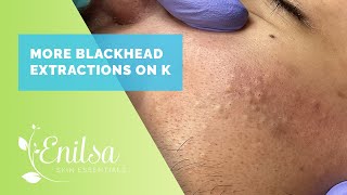 More Blackhead Extractions with K [upl. by Addiel]