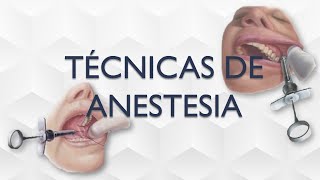 TECNICAS DE ANESTESIA LOCAL ODONTOLOGIA REPASO [upl. by Ranson865]