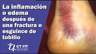 Inflamación de tobillo después de una fractura o esguince  Centro de Terapia Física de Tijuana [upl. by Everrs]