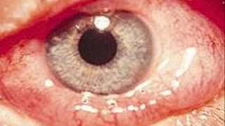 QUEMOSIS  INFLAMACIÓN O EDEMA DE LA CONJUNTIVA OCULAR [upl. by Erin680]