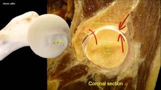 Femoral neck fracture  applied anatomy [upl. by Wilber]