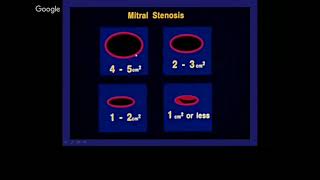 Echocardiography for Surgeons Part III Mitral Regurgitation and Mitral Stenosis [upl. by Huldah]