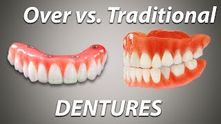 Over Denture vs Traditional Denture [upl. by Stepha765]