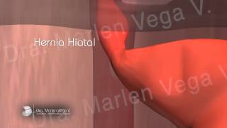 Dra Vega Cirugía de Hernia Hiatal – Video animado [upl. by Farris]