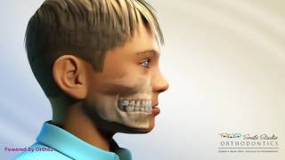 Facemask With Hyrax  Orthodontic Device [upl. by Sebastian892]