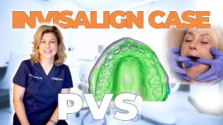 How To Take PVS Dental Impressions for Invisalign [upl. by Saduj877]