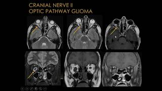 Cranial Nerves MRI Diagnostics  Part 1  Basic Radiology [upl. by Gates361]