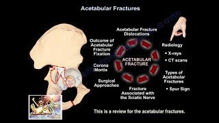 Acetabulum fracture anatomy OTA lecture series III v04a [upl. by Vyky]