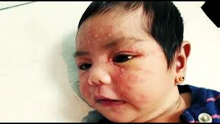 Neonatal cephalic pustulosis mimicking Neonatal Acne Erythema toxicum [upl. by Nolyak925]