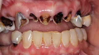 Why teeth get sensitive and how to fix it [upl. by Lubbock]