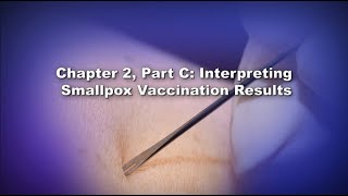 Chapter 2 Part C Interpreting Smallpox Vaccination Results [upl. by Eilzel821]