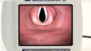 GlideScope Titanium 4Step [upl. by Sheaff]