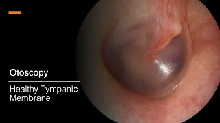 Tympanic Membrane Otosopy [upl. by Reisfield]