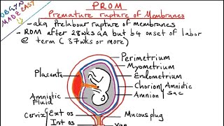 Premature Rupture of Membranes Prom [upl. by Philipines]