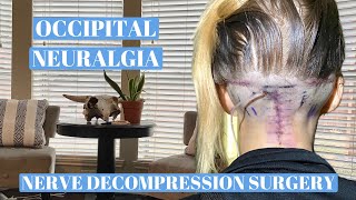 Occipital neuralgia Nerve decompression surgery recovery [upl. by Edward]