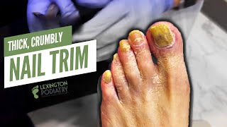 Thickened Crumbly Nail Trim [upl. by Norrehs]