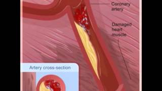 Como se produce un infarto al corazon [upl. by Ailices917]