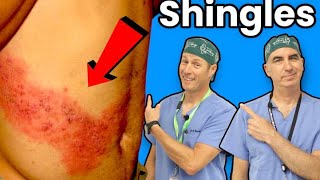 Shingles  You Definitely Dont Want This [upl. by Florence]