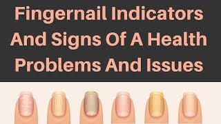 Fingernail Indicators And Signs Of A Health Problems And Issues [upl. by Zollie]