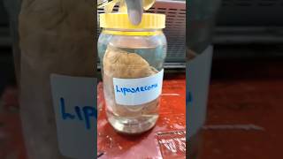 Grossing of liposarcoma specimen  histopathology Lipoma liposarcoma [upl. by Pisarik]