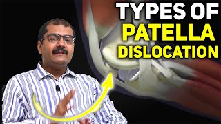 Understanding Types of Patella Dislocation Causes Symptoms and Treatment Options [upl. by Moule281]