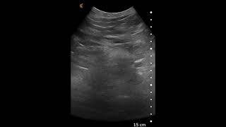 Abdominal Aortic Aneurysm AAA  Ultrasound Image Interpretation [upl. by Lluj]