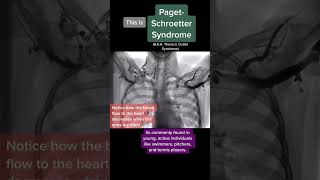 Cool visualization of Thoracic Outlet Syndrome [upl. by Vikki]