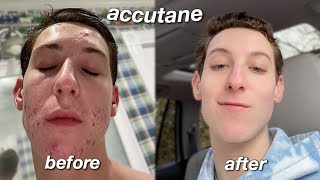 MY ACCUTANE JOURNEY  six month skin transformation [upl. by Margarete]