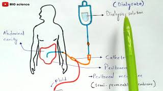 Types of dialysis  Intermittent dialysis  Peritoneal dialysis  Continuous renal replacement [upl. by Heady549]