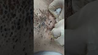 Nevus Comedonicus removal [upl. by Etteval]