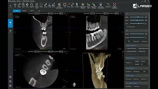 Dental Analysis Software  How LargeV small FOV achieves more [upl. by Hgiellek]