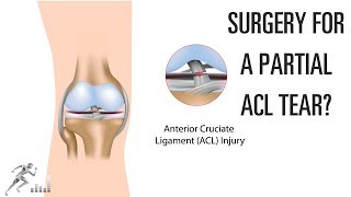 Do you need surgery for a partial ACL tear [upl. by Gross]