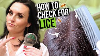 How to Get Rid of Head Lice NaturallyNONTOXIC Treatment Options and How To Prevent It [upl. by Nevsa]