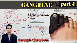 General Pathology lectures  GANGRENE  Hindi dry wet gas gangrene [upl. by Nivlek]