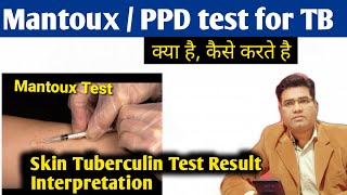 What is Mantoux Test for TB  Procedure and Interpretation Tuberculin Test Result  PPD Test [upl. by Burkitt994]