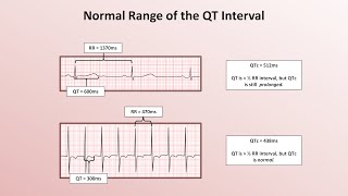 Advanced EKGs  The QT Interval and Long QT Syndrome [upl. by Delcine]