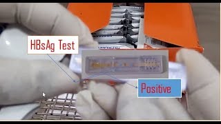 HBsAG Test Positive Hepatitis B test result within 20 minutes Hepatitis B test procedure [upl. by Hsirk626]