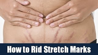 How to Rid Stretch Marks [upl. by Acirred]