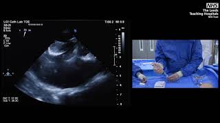 How to start using the Gore cardioform ASD occluder Four simple cases and step by step teaching [upl. by Federico]