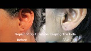 Split Earlobe Repair [upl. by Jennings]