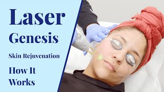 What is Laser Genesis  Cosmetic Treatments at BYou Laser Clinic [upl. by Neelrak]