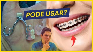 Quem usa prótese pode usar aparelho [upl. by Wynn300]